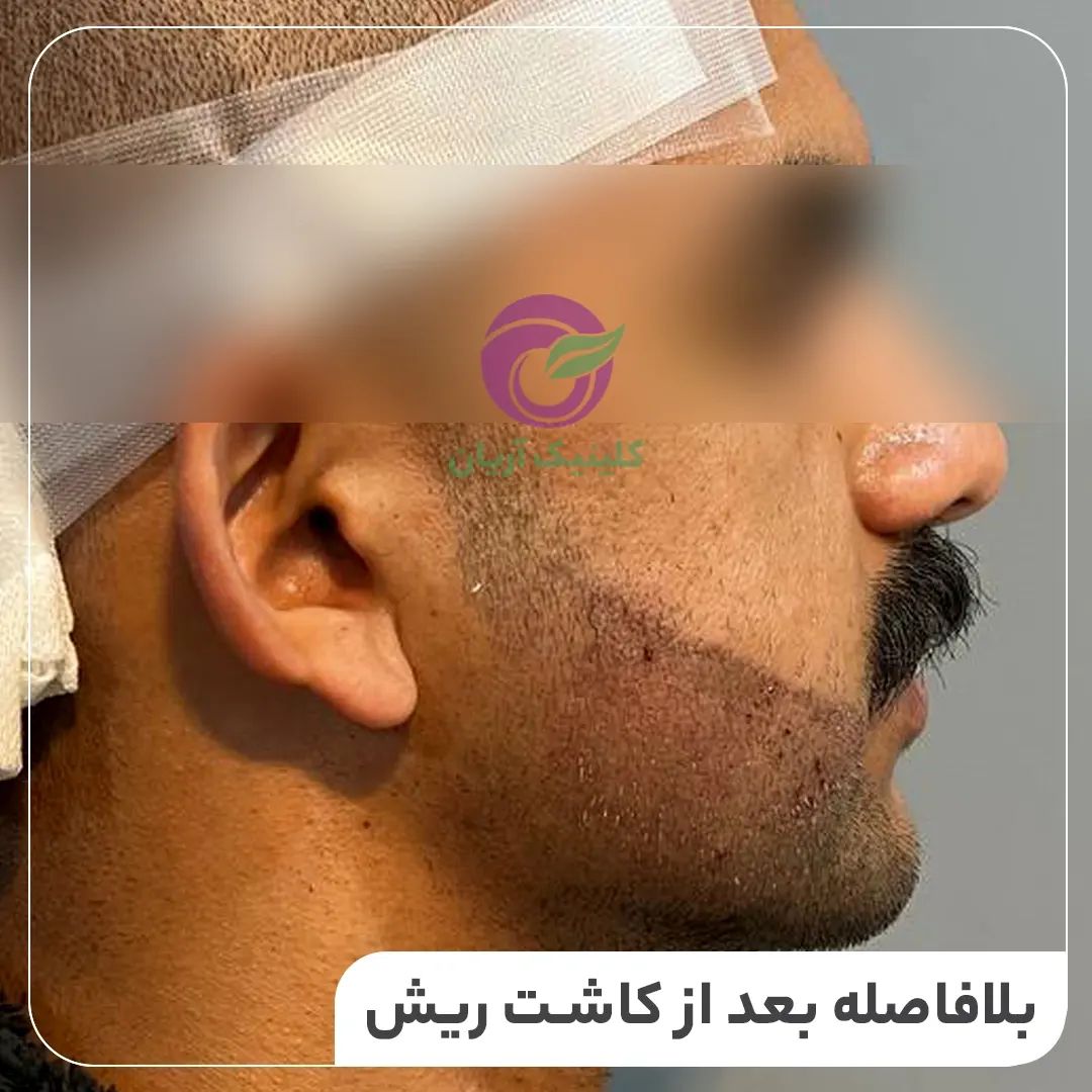 گالری کاشت ریش و سبیل